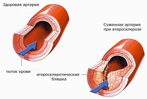 ateroskleroz