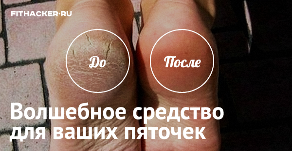 Волшебное средство для ваших пяточек. Моментальный эффект!