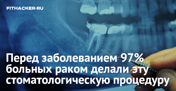 Перед заболеванием 97% больных раком делали эту стоматологическую процедуру