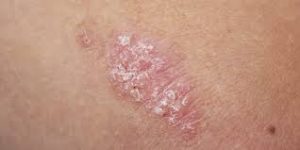 psoriasis