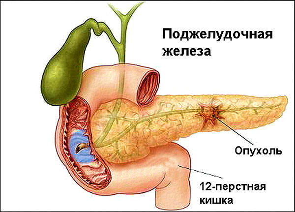 7 симптомов рака поджелудочной железы. Вы не должны их игнорировать!